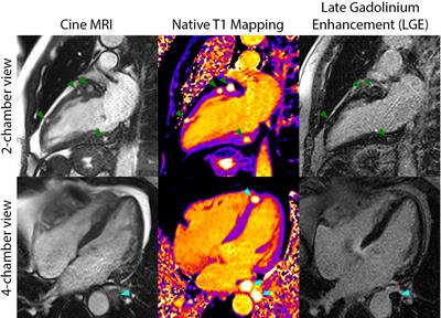 Fast Clearance of the SARS-CoV-2 Virus in a Patient Undergoing Vaccine Immunotherapy for Metastatic Chordoma: A Case Report